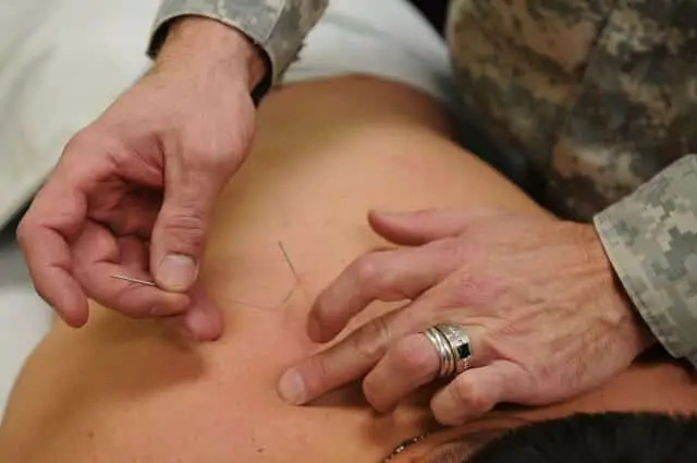 The Difference between Acupuncture and Acupressure
