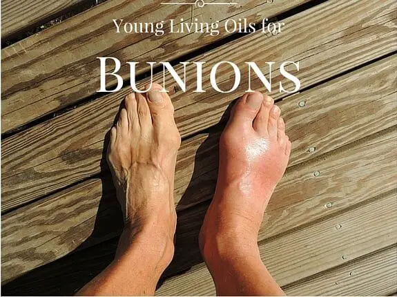 Young Living Oils for Bunions
