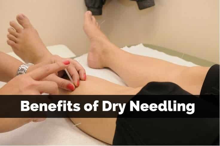 Benefits of Dry Needling Benefits of Dry Needling
