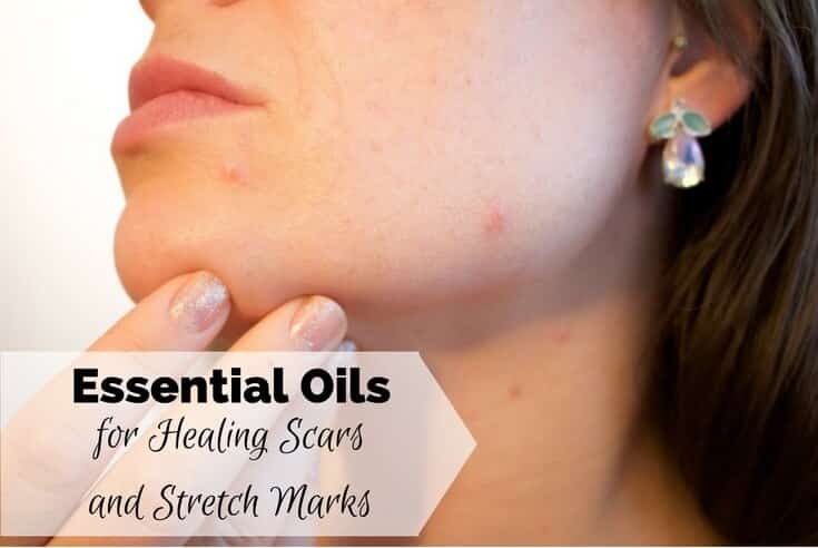 Essential Oils for Healing Scars and Stretch Marks Essential Oils for Healing Scars and Stretch Marks
