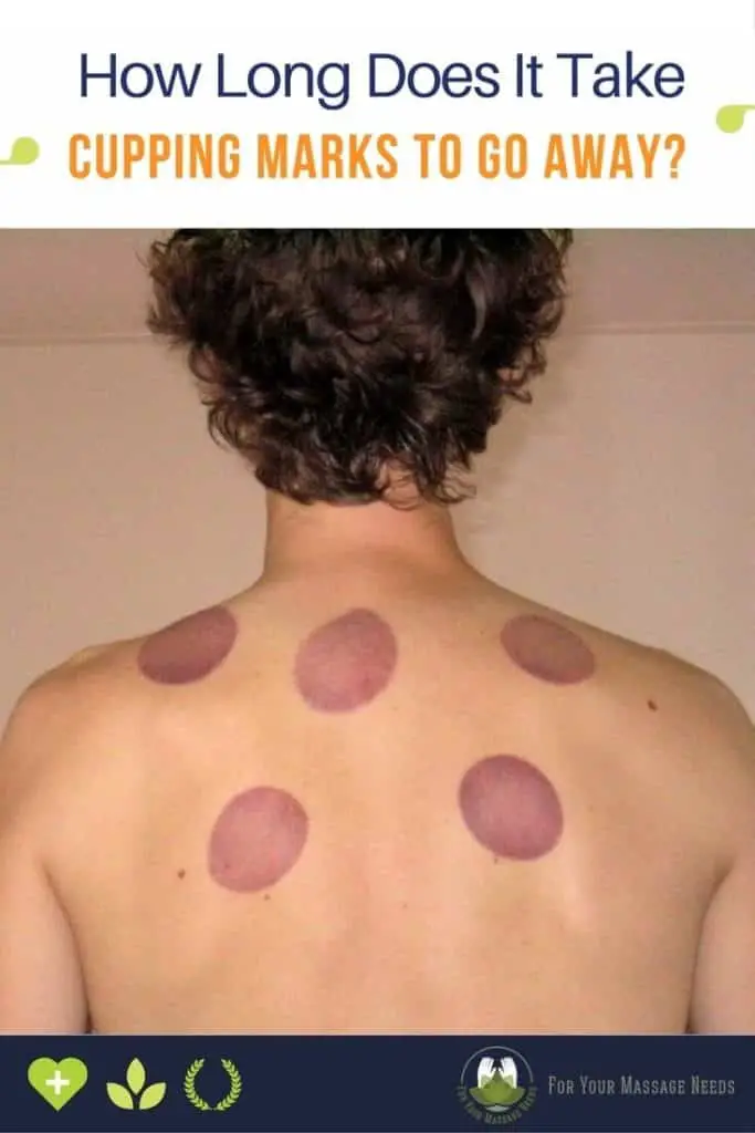 How Long Does It Take for Cupping Marks to Go Away