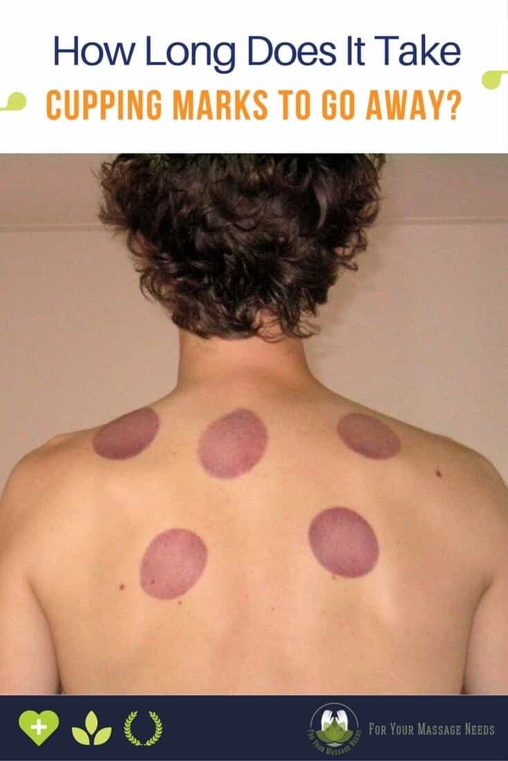 How Long Does It Take for Cupping Marks to Go Away How Long Does It Take for Cupping Marks to Go Away