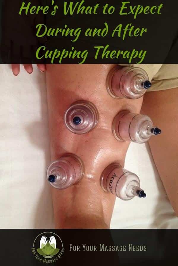 What to Expect After Cupping